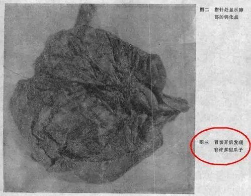 辛追吃瓜死亡,一场悲剧引发的食品安全警钟-第2张图片-网曝911黑料热点事件